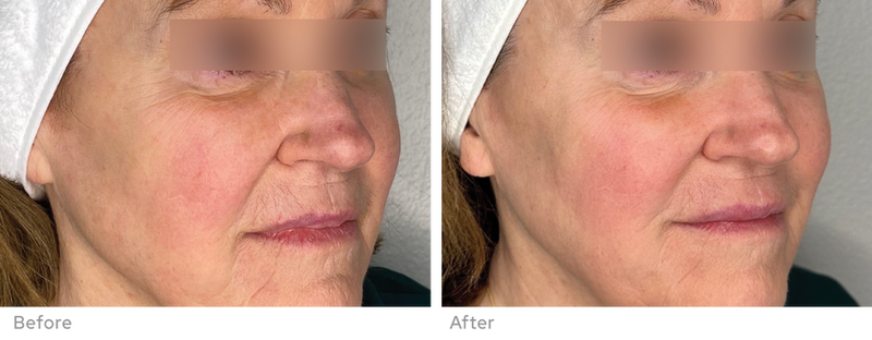 Sylfirm X clinical result