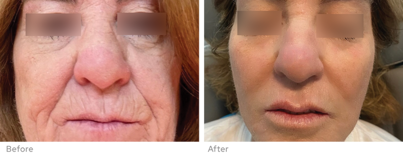 Sylfirm X clinical result