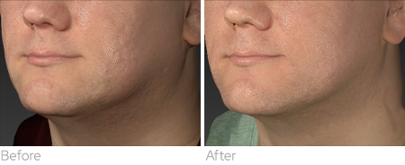 Sylfirm X clinical result