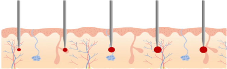 Insulated electrode coagulation